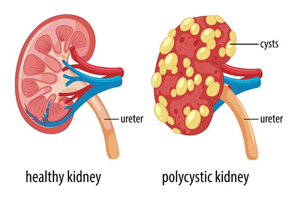 Ayurvedic kidney specialist | Ayurvedic kidney treatment