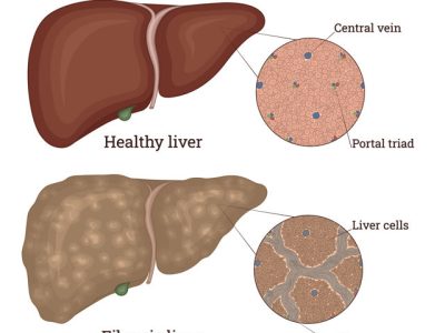 Illustration of Liver Disease – Fibrosis, which is an overgrowth of scar tissue Illustration of Liver Disease - Fibrosis, which is an overgrowth of scar tissue