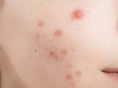 Acne Vulgaris Acne Vulgaris