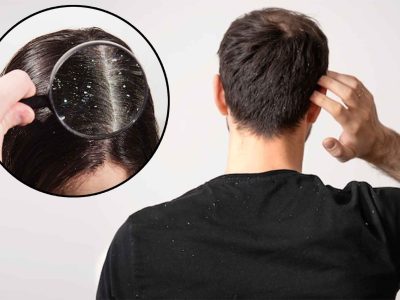 Dandruff – Symptoms, causes Dandruff - Symptoms, causes