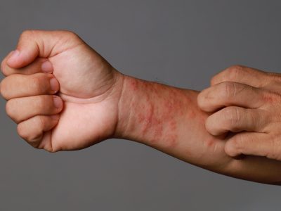 Eczema-Wrist-blog-header-scaled Eczema-Wrist-blog-header-scaled