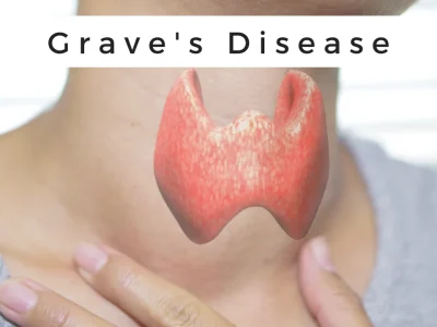 Graves Disease Graves Disease