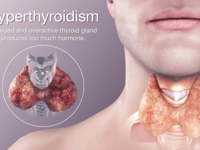 Hyperthyroidism-1536×864 Hyperthyroidism-1536x864
