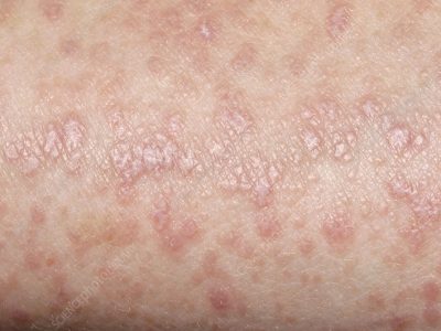Lichen planus disease Lichen planus disease. Close-up of the skin of a 49 year old woman with lichen planus, showing inflamed rash-like lesions. This condition affects middle-aged adults but has an unknown cause. In some cases it may be of nervous or emotional origin (such as severe stress) but in others it may be an allergic reaction or due to drugs. In this case, it may be a side-effect of the ACE (angiotensin-converting enzyme) inhibitor drug Perindopril, which is used to treat hypertension and heart disease.