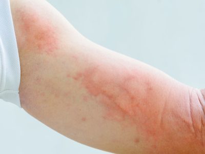 Urticaria Urticaria