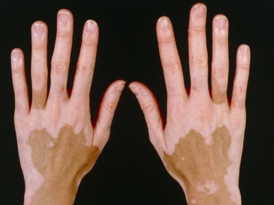 Vitiligo Vitiligo