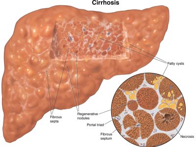 cirrhosis-of-the-liver cirrhosis-of-the-liver