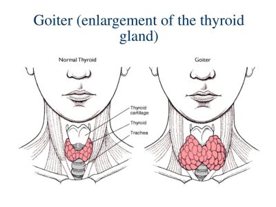 goiter goiter
