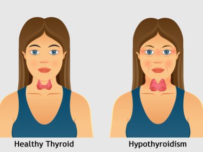 hypothyroidism-causes hypothyroidism-causes
