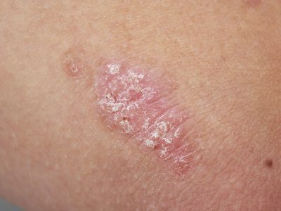 psoriasis-136810224-579650e55f9b58461fd00923 psoriasis-136810224-579650e55f9b58461fd00923
